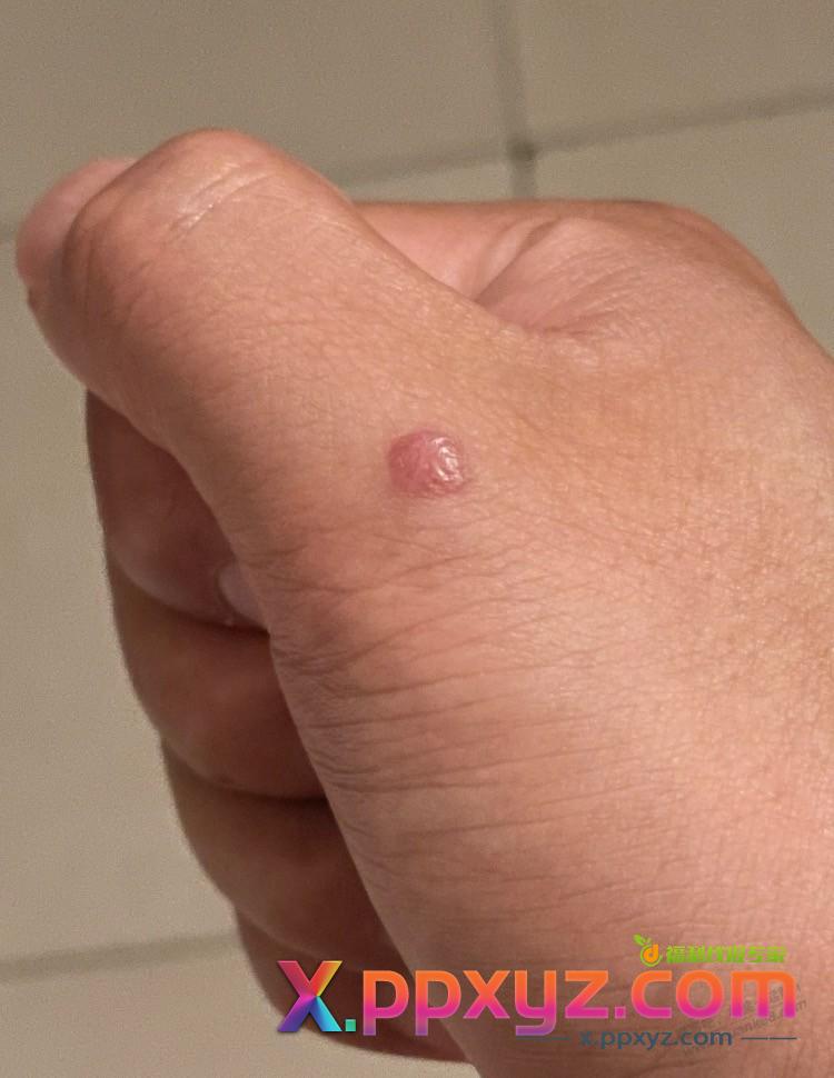 大拇指关节这个部位被玻璃划伤愈合几个月了 但是按上去好像还是有点疼 - PPXYZ线报
