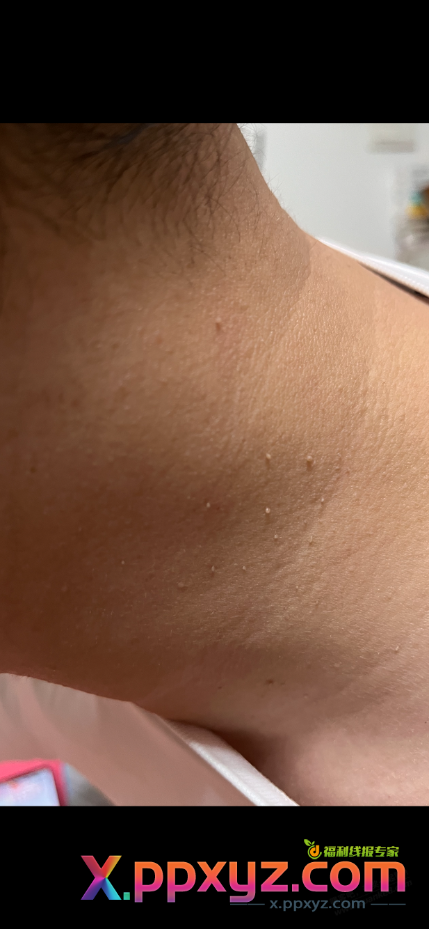吧医在吗？脖子上最近长了一圈这个是什么？是皮赘还是丝状疣？ - PPXYZ线报