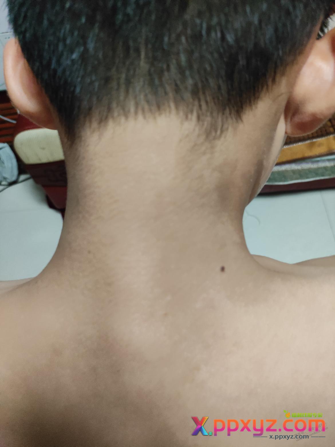 求助彦祖吧友，小孩脸上和脖子有黑色斑 - PPXYZ线报