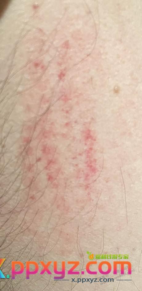 吧友们，洗澡时下体挠红一片，是什么情况呢？女吧友勿入（如图） - PPXYZ线报